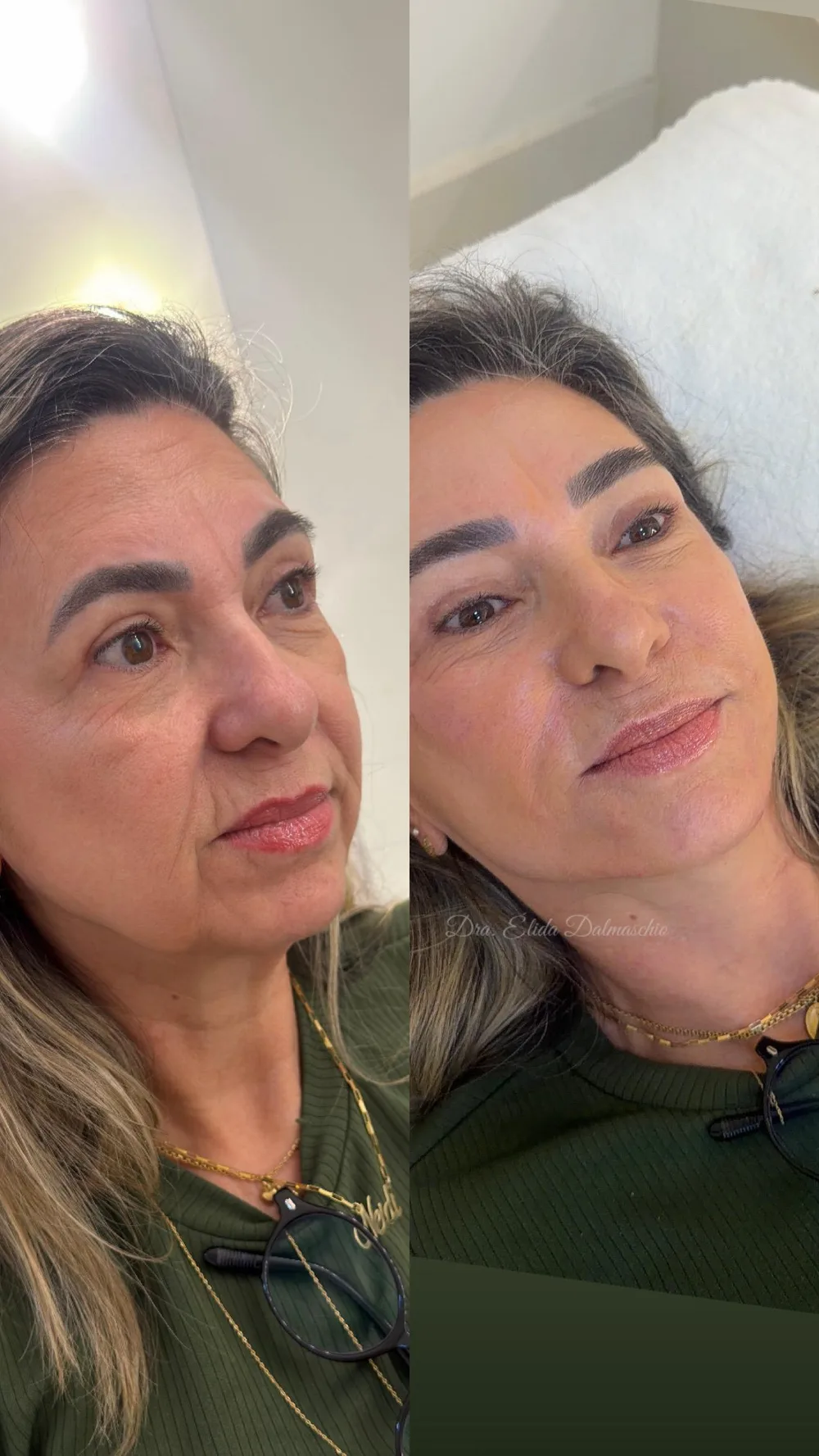 Antes e depois de harmonização facial realizada pela Dra. Élida Dalmaschio