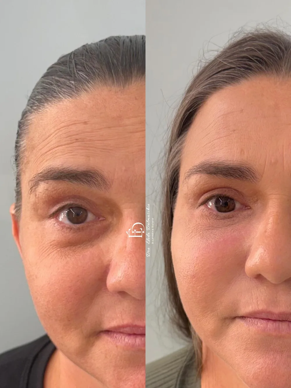 Resultado de harmonização facial realizado pela Dra. Élida Dalmaschio