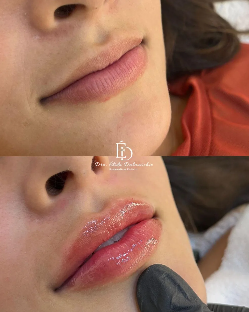 Antes e depois de preenchimento labial realizado pela Dra. Élida Dalmaschio